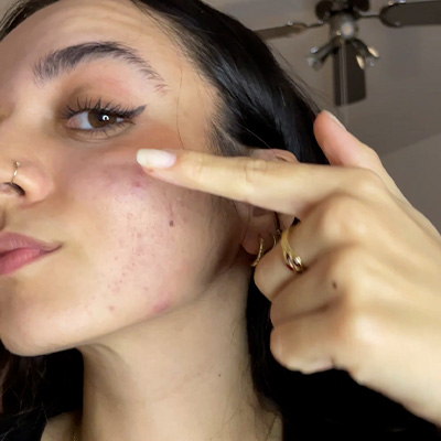 Parches-para-granos-simple-pimple-funcionan elimina-el-acne-con-estos-parches-para-granos