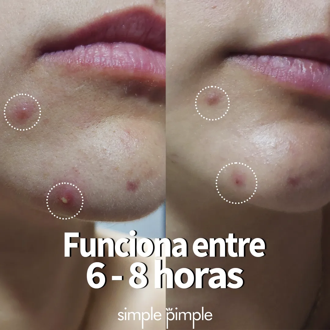 Pimple-Patches-simple-pimple-invisibles3