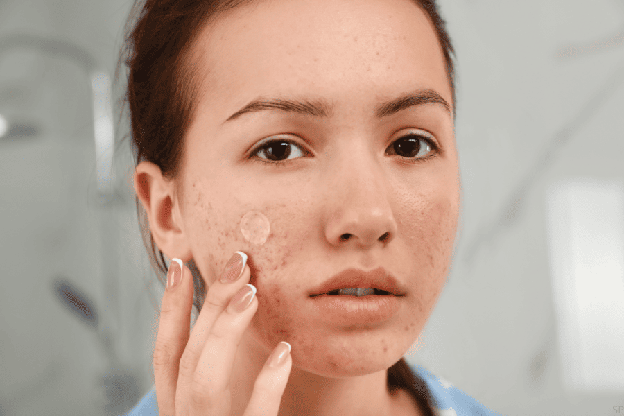 Por que mi parche para el acne no está funcionando