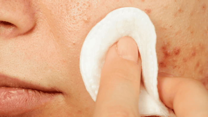 ¿Por qué mi parche para el acné no está funcionando? 1 Por que mi parche para el acne no está funcionando