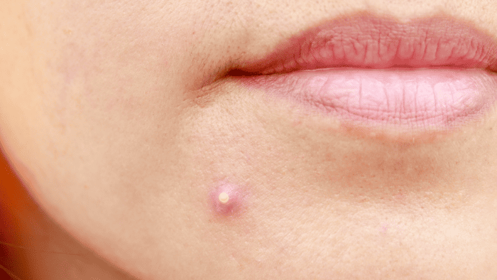 ¿Por qué mi parche para el acné no está funcionando? 2 Por que mi parche para el acne no está funcionando