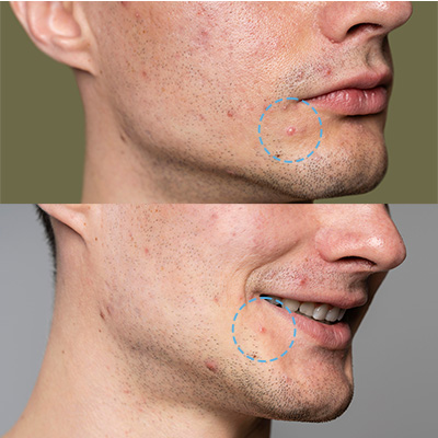 Simple Pimple Night 6
