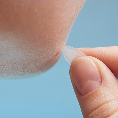 Simple Pimple Original - Parche para Granos 4