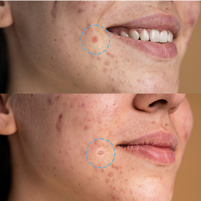 Simple Pimple Original - Parche para Granos 8 Simple Pimple Original - Parche para Granos 8