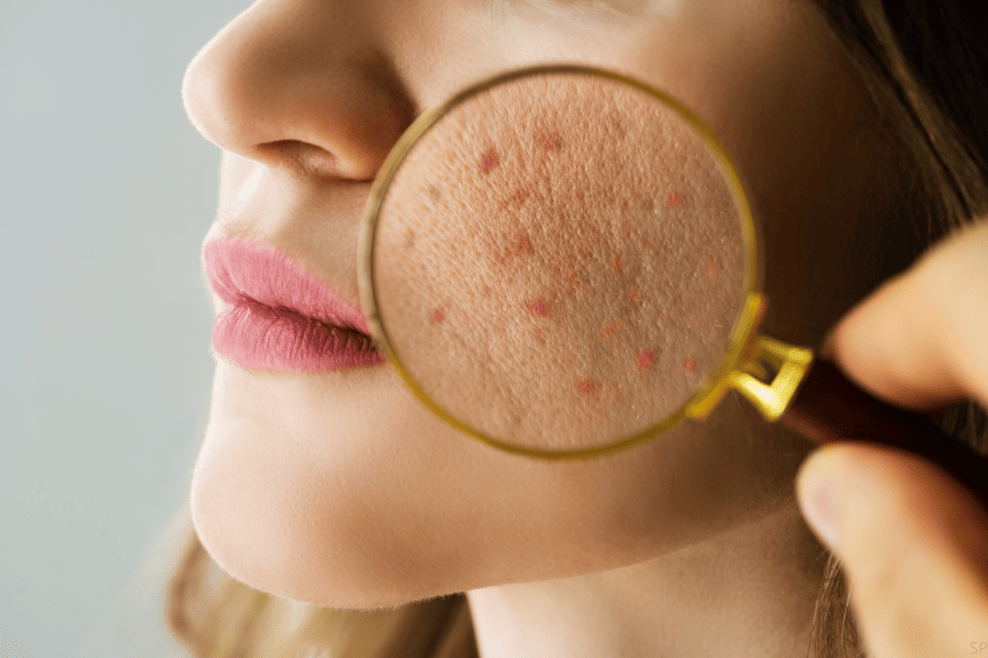 Todos sobre el acne