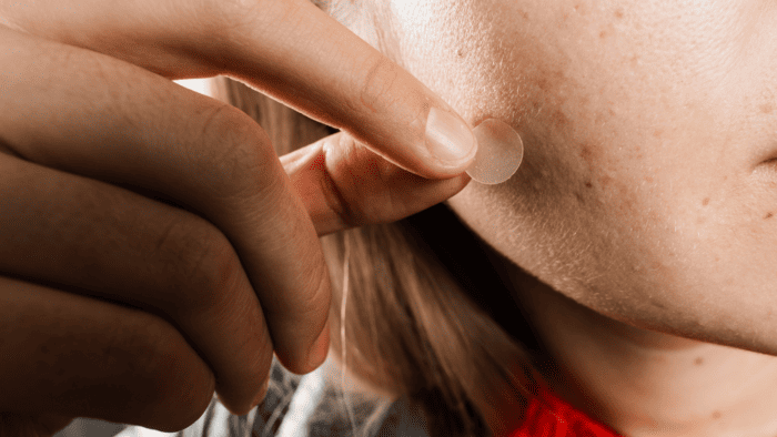 Todo Acerca del Acné: Tipos, Tratamientos y Consejos Prácticos 1 Todos sobre el acne